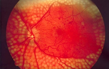 Natural Compound Stops Diabetic Retinopathy