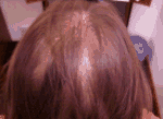 <b>Hair Loss/Thinning hair</b>