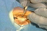 Cataract Surgery