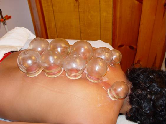 Cupping